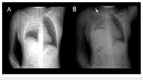 Chest X-ray. (A) Preoperative and (B) postoperative, arrow shows fibula ...