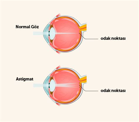 Astigmat Nedir Astigmat Belirtileri Nelerdir Güven Hastanesi