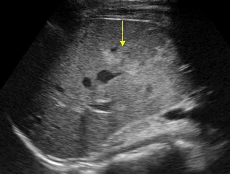 Wk 2 Liver Pathology Liver Rupture With A Hyperechoic Hematoma Ultrasound Sonography