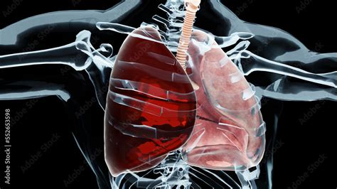 3d Illustration of Hemothorax, Normal lung versus collapsed, symptoms of Hemothorax, pleural ...