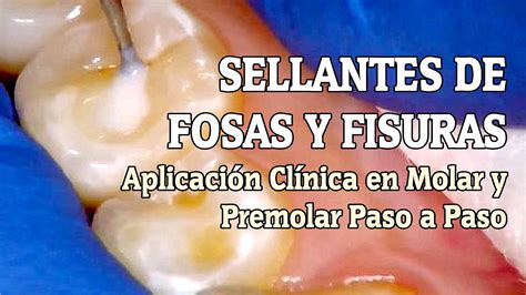 SELLANTES DE FOSAS Y FISURAS Aplicación Clínica en Molar y Premolar