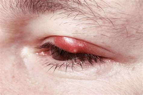 Types Of Blepharitis And Causes Usa News Corner