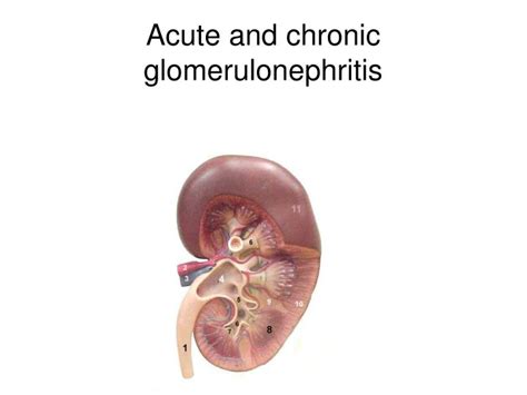 PPT - Acute and chronic glomerulonephritis PowerPoint Presentation, free download - ID:3623150