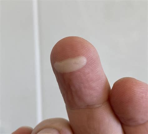 Burn Blister On My Finger Looks Like An Among Us Character R