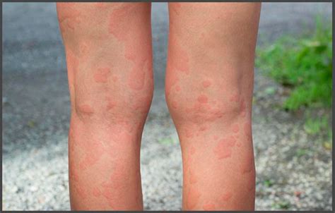 Shingles on leg pictures | Shingles Expert