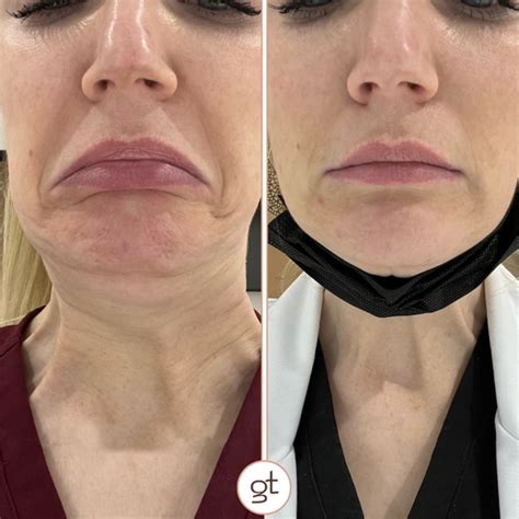 Before And After Botox Gallery Dramatic Transformations