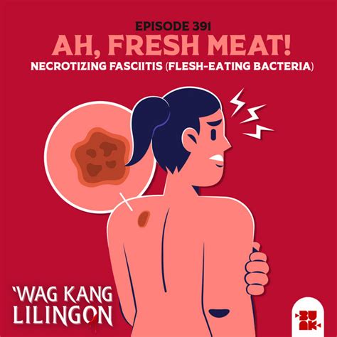 Episode Ah Fresh Meat Necrotizing Fasciitis Flesh Eating