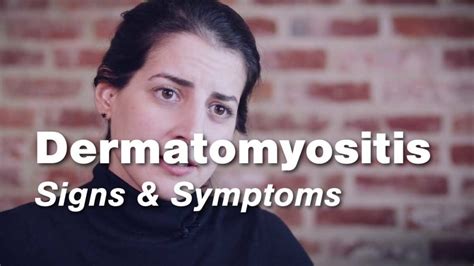 Polymyositis Signs And Symptoms Johns Hopkins Rheumtv