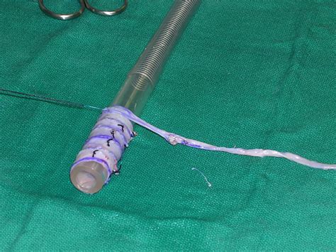 Spiral Vein Graft For Svc Stenosis Ctsnet