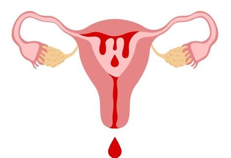 Abnormal Uterine Bleeding A Simple Guide Sukhi Pariwar Clinic