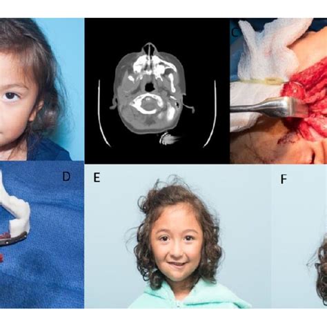 Mandible reconstruction patient: (A) patient presenting with a right... | Download Scientific ...