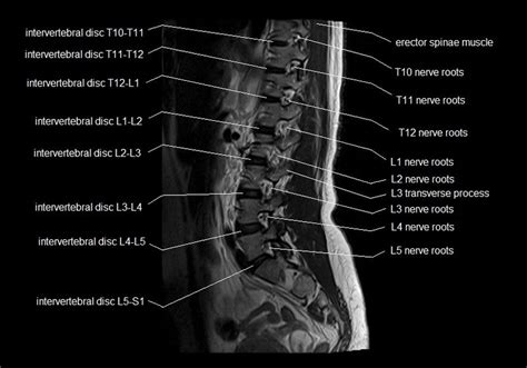 Lumbar Spine Sagittal