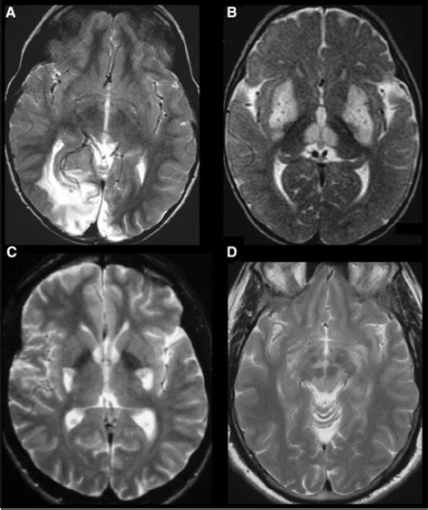 Brain MRI A Axial T2 Weighted Image Of The Brain Of Patient 1