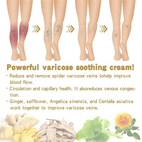 Varicose Veins Treatment Cream, Varicose Vein Soothing Leg Cream ...