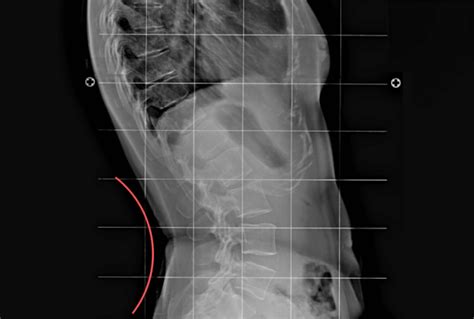 symptoms of lumbar lordosis Archives - Spinal Backrack