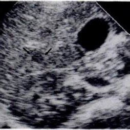 -6-year-old girl with fever and regional axillary adenopathy.... | Download Scientific Diagram