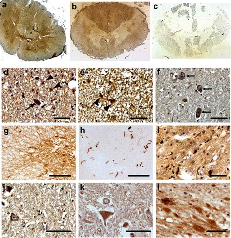 Transverse Spinal Cord Sections From An Als Patient With Download Scientific Diagram