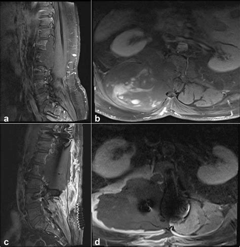 Case 5 Sagittal A And Axial B Post Contrast T1 Weighted Images