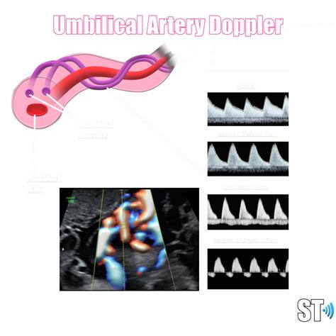 Umbilical Artery Doppler – Sonographic Tendencies