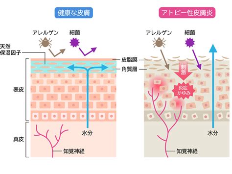 アトピー性皮膚炎の要因（どうしてなるのか） 患者・家族の方へ 認定npo法人アレルギー支援ネットワーク