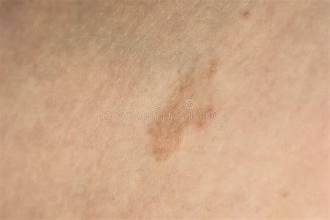 Pityriasis Rosea Three Weeks After The Appearance Of The First Focus On