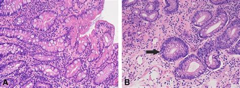 Photomicrographs Of Gastric Intestinal Metaplasia A Complete Type With