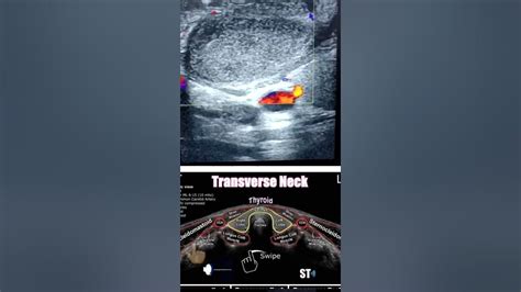 Fibromatosis Colli Or Pseudotumour Of Right Sternocleidomatoid Muscle Youtube