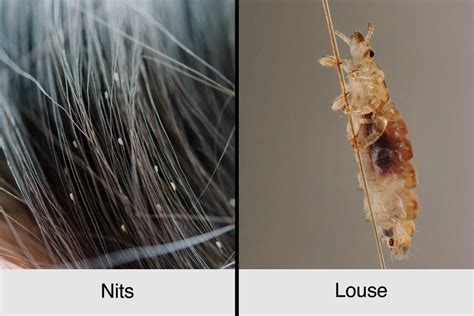 A Guide to Head Lice: Symptoms, Treatments, Prevention | The Healthy