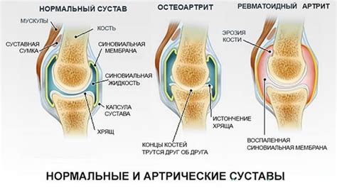 Остеоартрит (остеоартроз)
