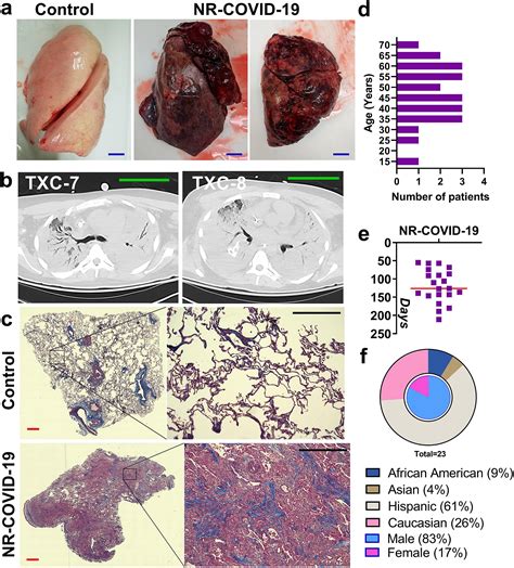 Fulminant Lung Fibrosis In Non Resolvable Covid 19 Requiring