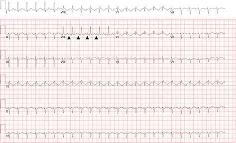 Successful Fluoroless Radiofrequency Catheter Ablation Of Supraventricular Tachycardia During