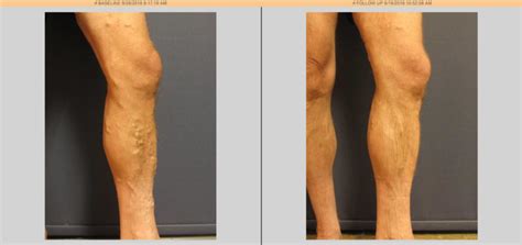 Vein Treatment Before And After Orange County Newport Beach