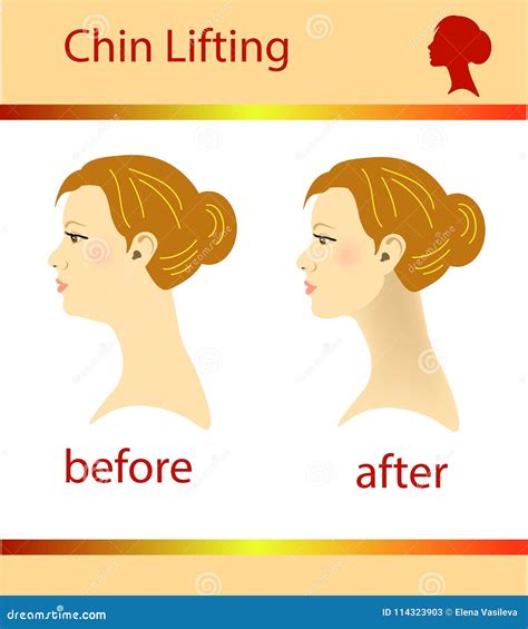 Illustration Of A Woman With A Double Chin And A Normal Chin Vector