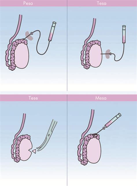 Recupero Testicolare Degli Spermatozoi TESA TESE MicroTESE