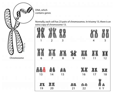 Trisomy 13 – Ohio Fetal Medicine Collaborative