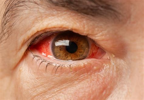 Blood In White Of Eye Causes Healing And When To Worry