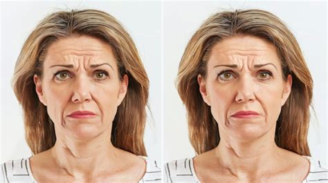 Premium Photo Middle Aged Woman Before And After Botox Treatment For