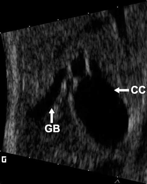 Prenatal Diagnosis Of Choledochal Cyst Using Ultrasound And Magnetic Resonance Imaging Chen