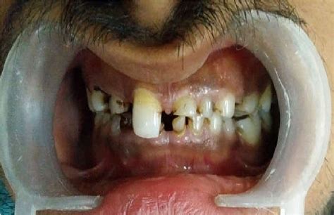 Figure From Non Syndromic Oligodontia With Multiple Retained