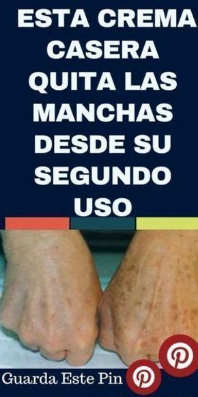 Qué podemos hacer con manchas y pecas en las manos quitar manchas de