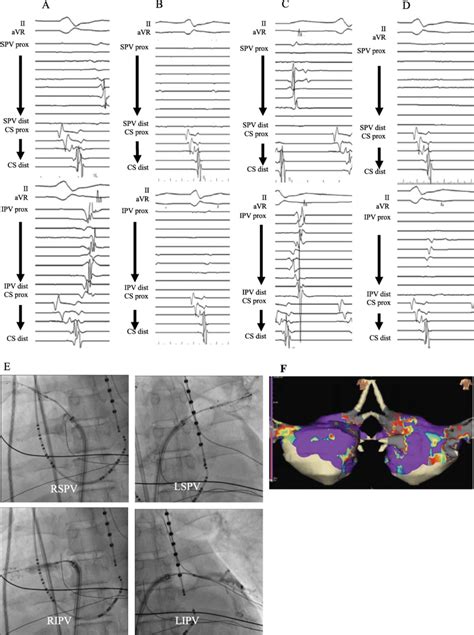 Pulmonary Vein Isolation Using Cryoballoon A Baseline Intracardiac Download Scientific