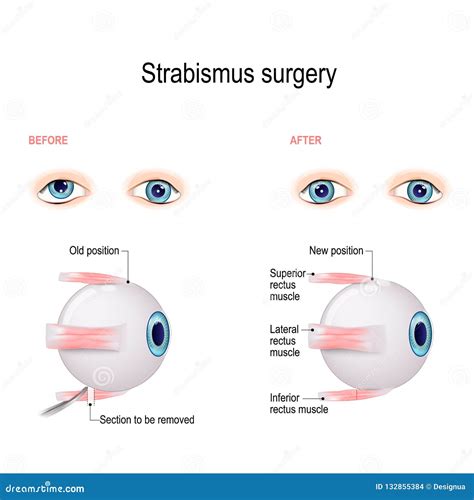 Cirugía Del Estrabismo Hypertropia Recesión Del Músculo De Ojo