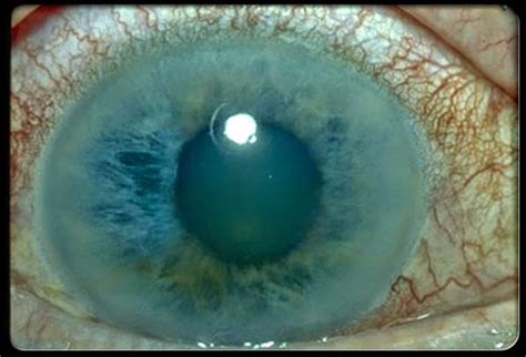 Glaucoma Eye Disorder Dream Health