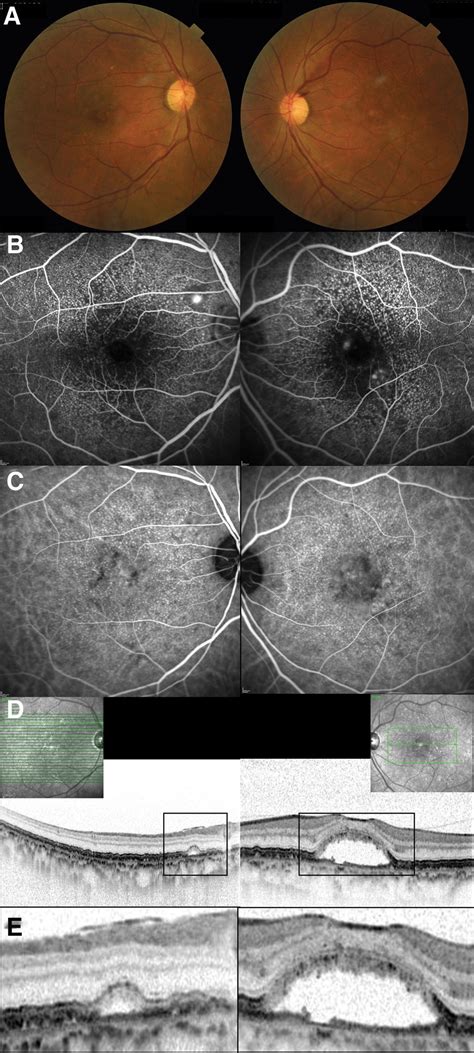 Cuticular Drusen Presenting With Central Serous Chorioretino Medicine