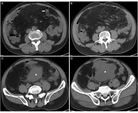 Liposarcoma Radiology