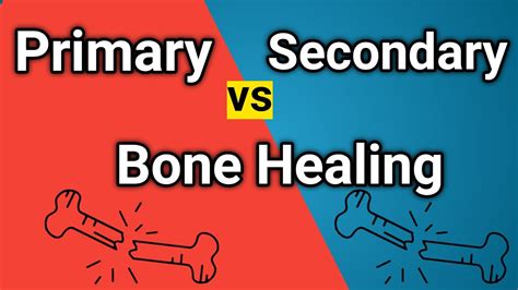 Primary Bone Healing Vs Secondary Bone Healing Fracture Healing Youtube