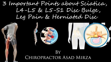 3 Important Points About Sciatica L4 L5 L5 S1 Disc Bulge Leg Pain