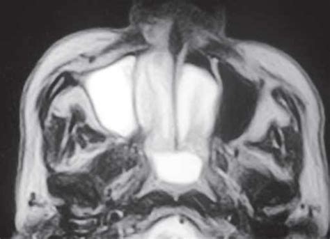 Nasal Polyp Mri