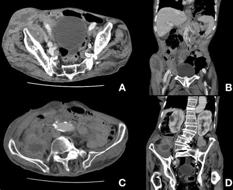 Ct Scan Abdomen Colon Cancer