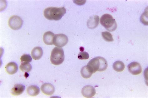 Imagen Gratis Plasmodium Falciparum La Malaria Parásitos Sangre Muestra Paciente